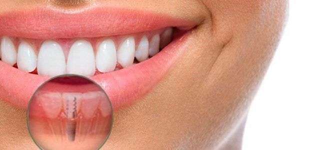 Beneficios de los Implantes dentales