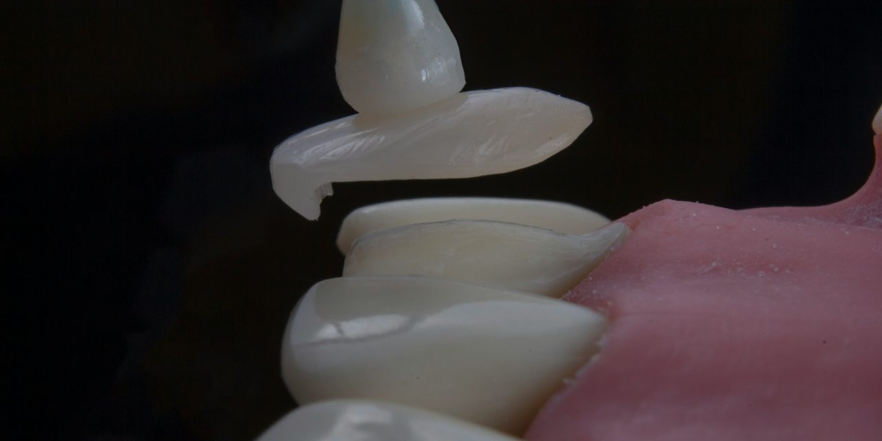 Carillas dentales en Zafra: transforma tu sonrisa con resultados naturales y duraderos